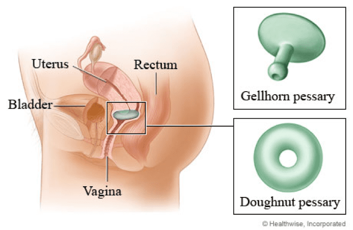 prolapse2